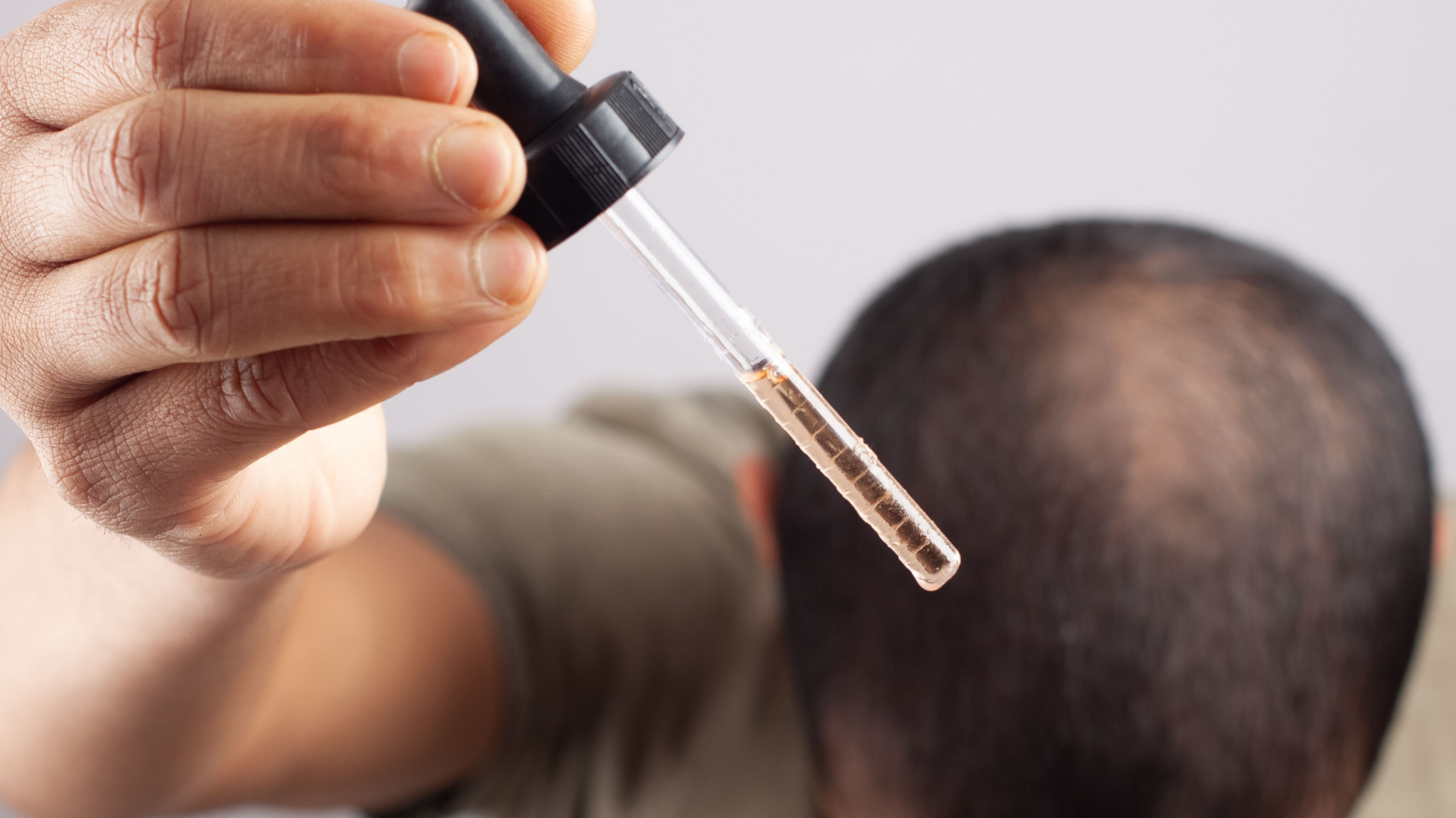 Mesotherapy vs. Minoxidil: Are Injections More Effective Than Topical Use?