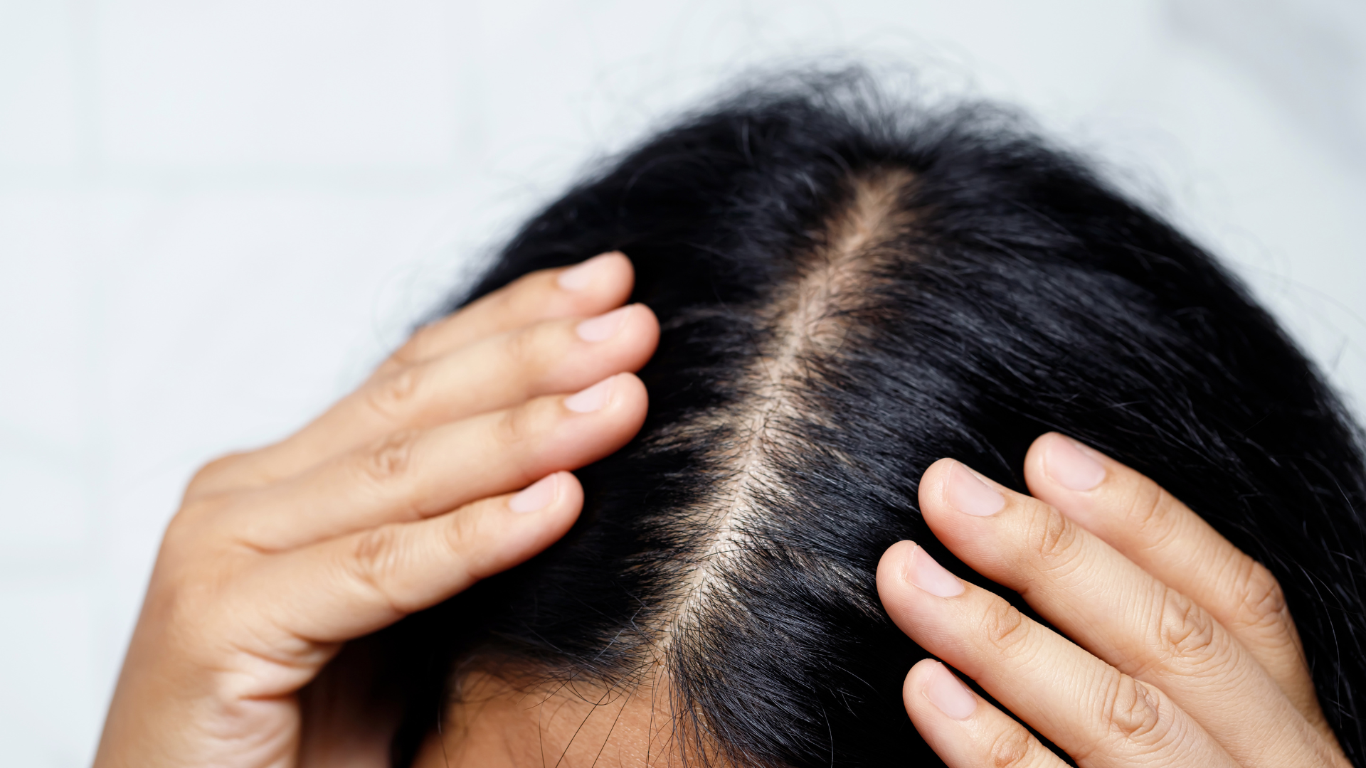 The Quiet Disruptor: Microinflammation May Be Behind Unexplained Hair Loss