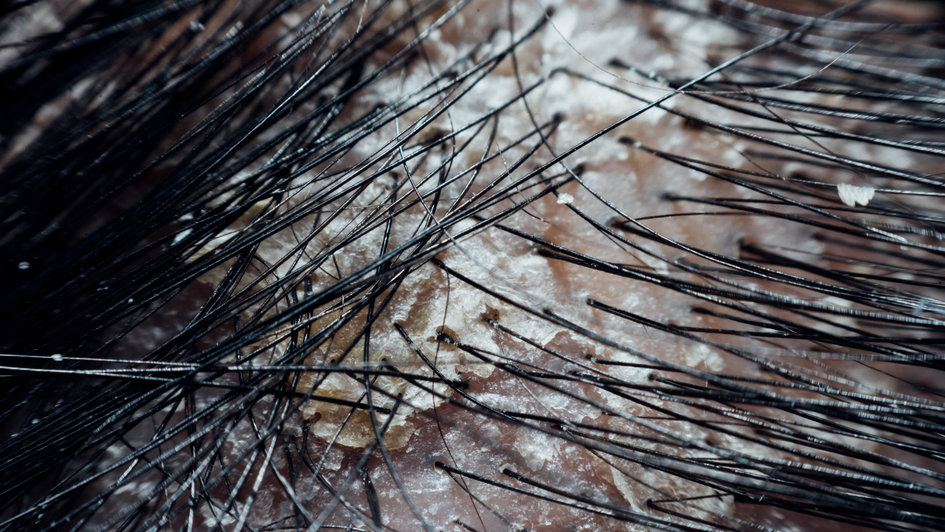 COVER STORY: The Truth About Dry, Sensitive Scalps