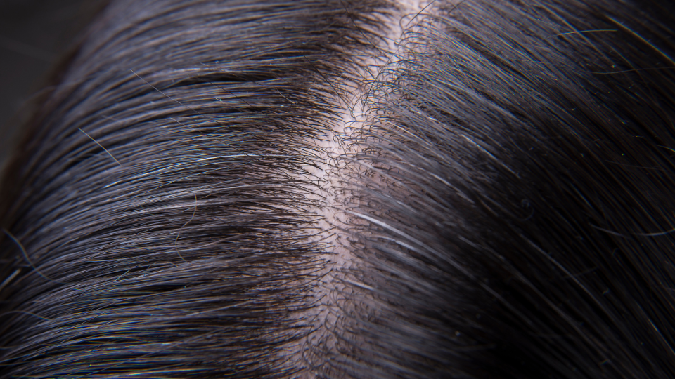 The Scalp Diet: Why Prebiotics Are the Future of Hair Health