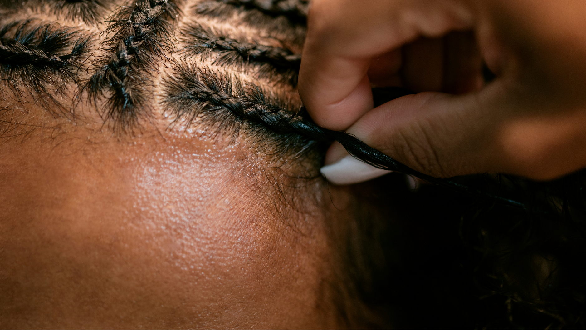 Can Mesotherapy Help with Traction Alopecia?