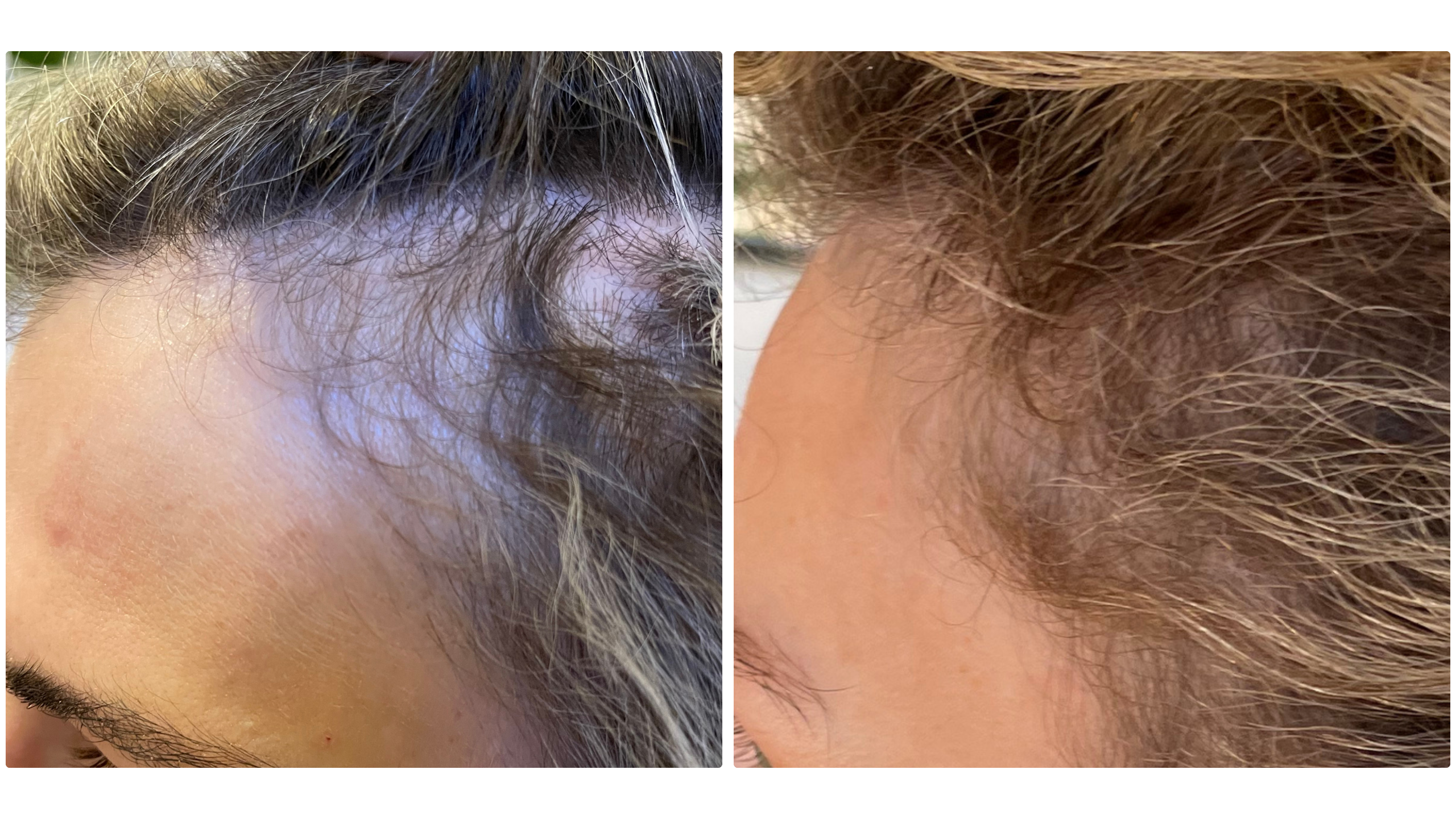 Chronic Telogen Effluvium: Recovery Timeline